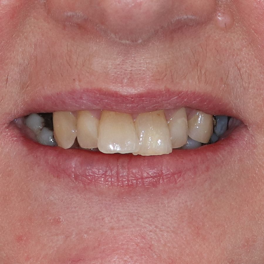 The 3Dental Guide to Crowns and Bridges Cosmetic Dentistry