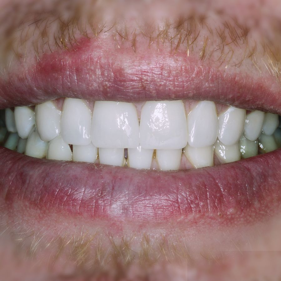 Diastema Explained Gaps In Teeth // 3Dental
