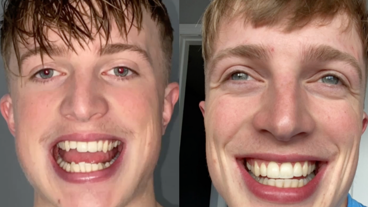 Six Months in Braces!