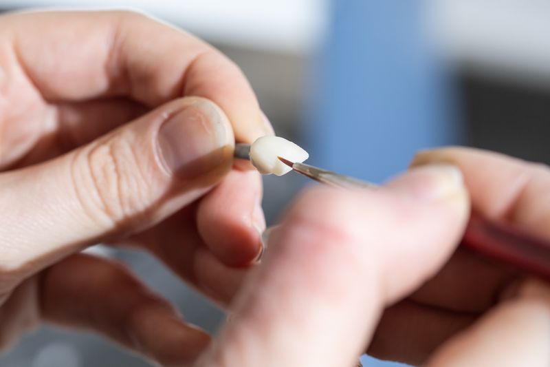 Dental Cosmetic Bonding Tooth Bonding // 3Dental In Dublin, Limerick